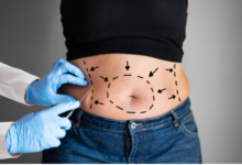 Liposuction Explained: Procedure, Results, and Recovery