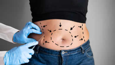 Liposuction Explained: Procedure, Results, and Recovery